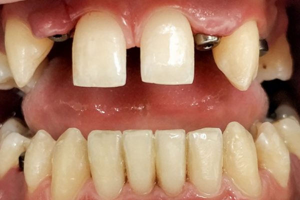 implant-dentaire-cas-clinique-avant